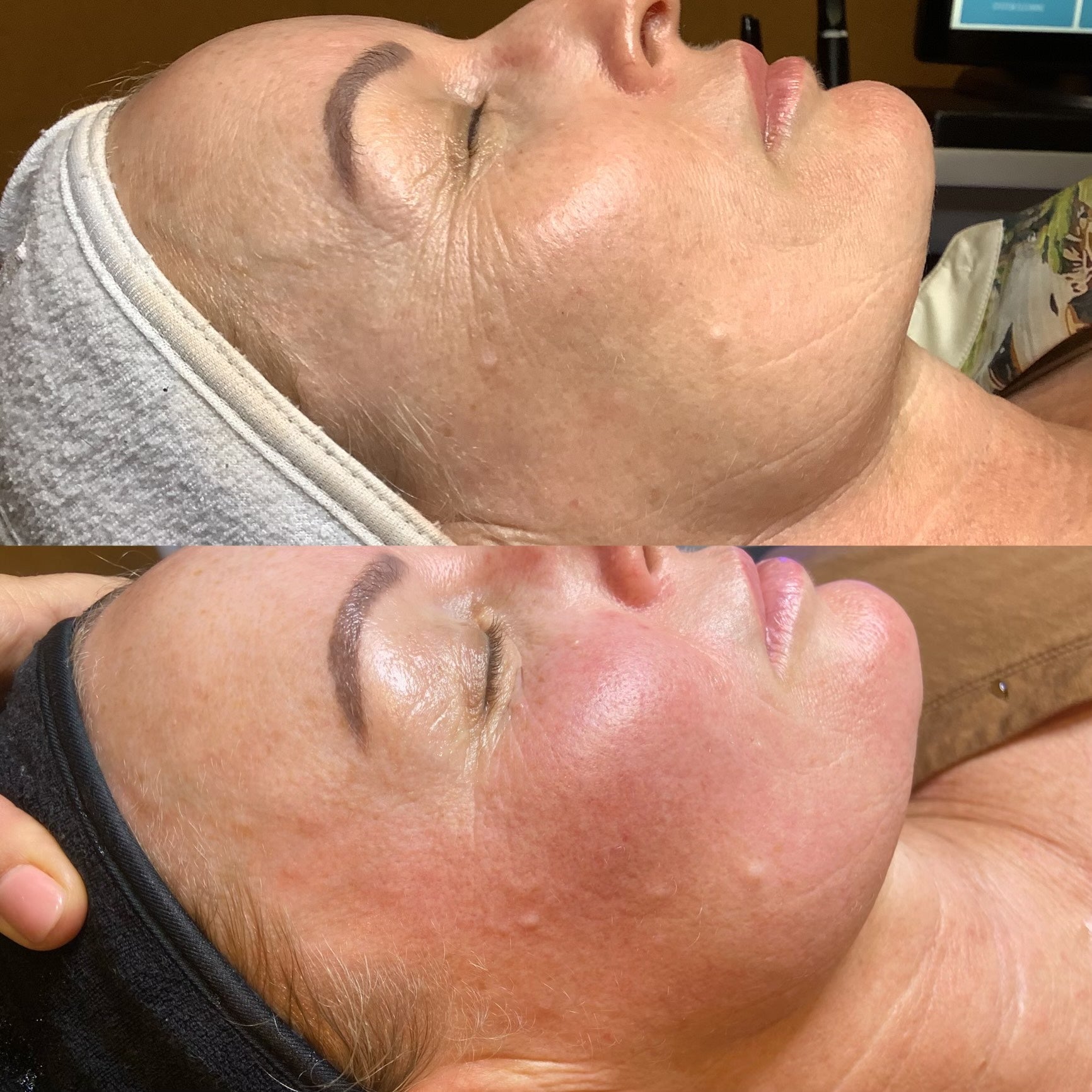 Forma RF Before & After at Light Years Skin Studio